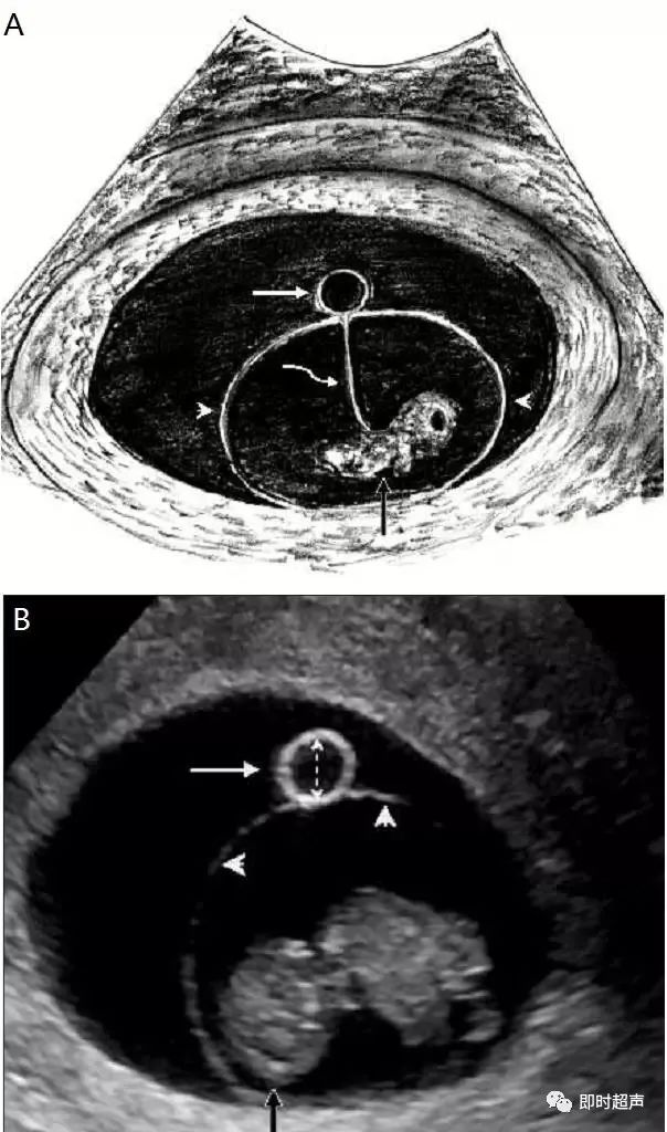 全面掌握卵黄囊的超声诊断