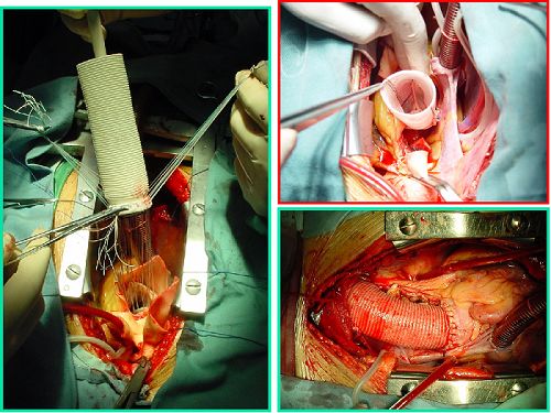 髂动脉支架植入术图片
