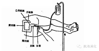 新生儿肛管排气图片