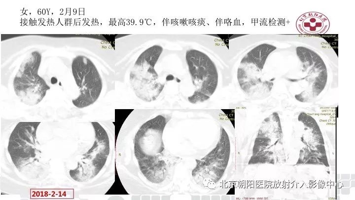 常见病毒性肺炎的ct影像表现