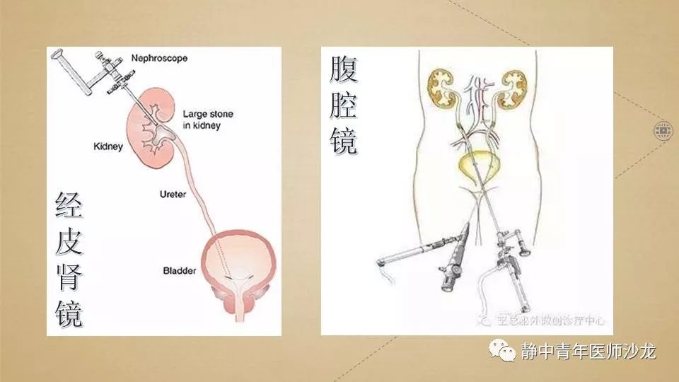 腹腔镜肾囊肿手术图解图片