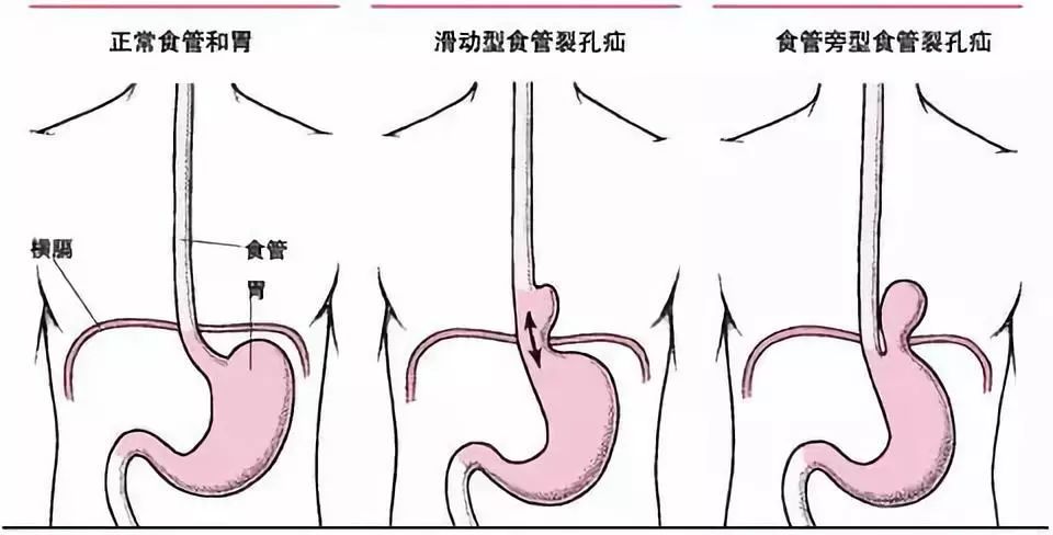 食管沟图片