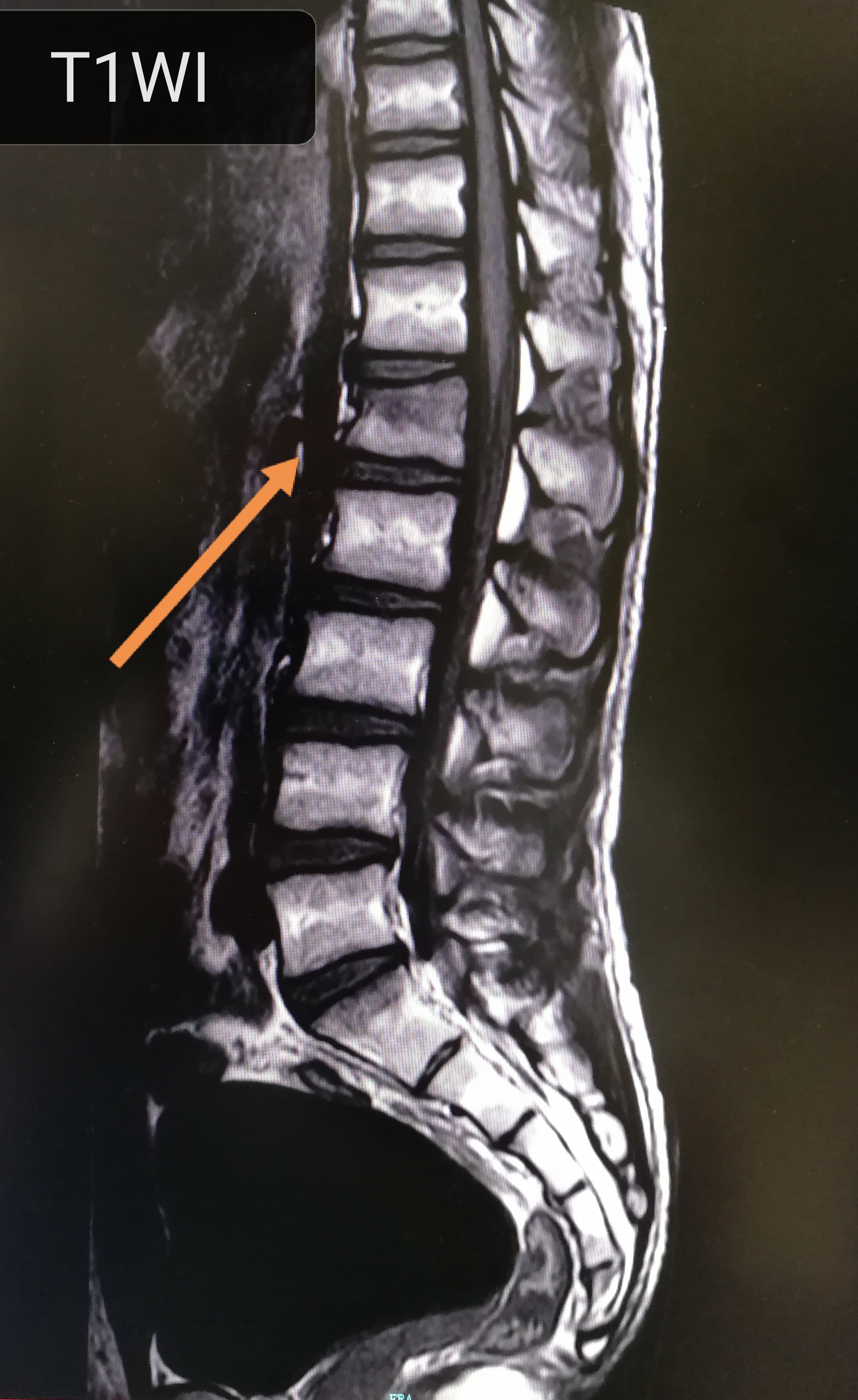l1腰椎压缩性骨折图图片