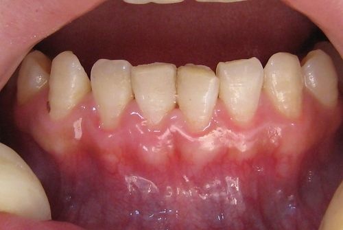 牙龈萎缩严重是怎么回事只覆盖牙齿的根部了有修复的办法吗