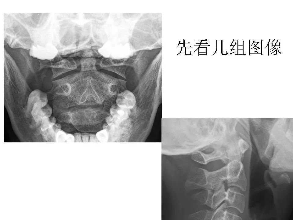 寰樞關節脫位影像診斷影像天地