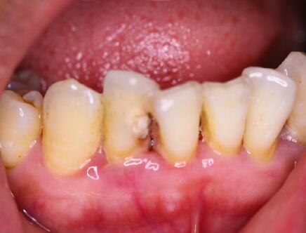 牙龈萎缩严重是怎么回事?只覆盖牙齿的根部了,有修复的办法吗?