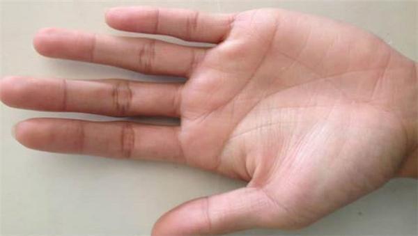 伴有手掌表层高低不平的现象;其次,如果小指外侧有青筋很可能就是先天