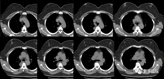 膈肌CT图片