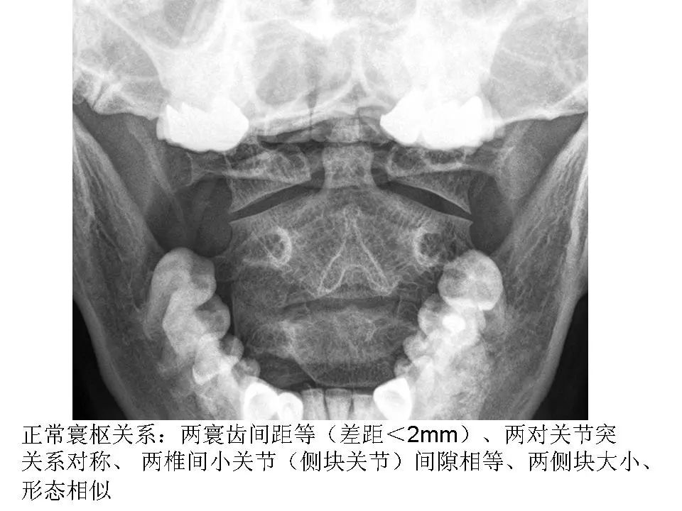 寰枢关节脱位影像诊断影像天地