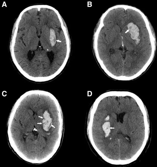 预测自发性脑出血血肿扩大的ct征象,不学就out了!