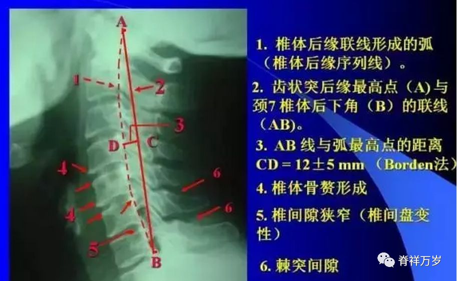 x光片解析颈椎病