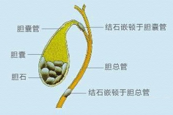 胆囊胆管图片清晰图片图片