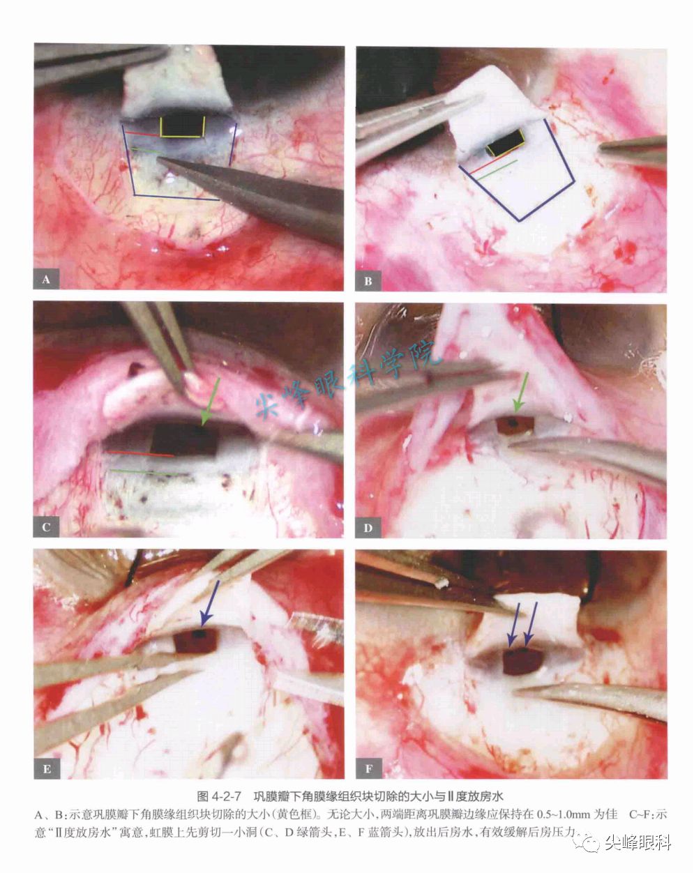小梁切除术的手术技术和其它问题解答part3图解青光眼手术操作与技巧