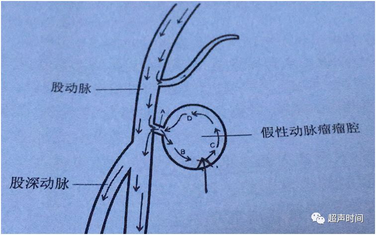 图 3 股动脉假性动脉瘤示意图
