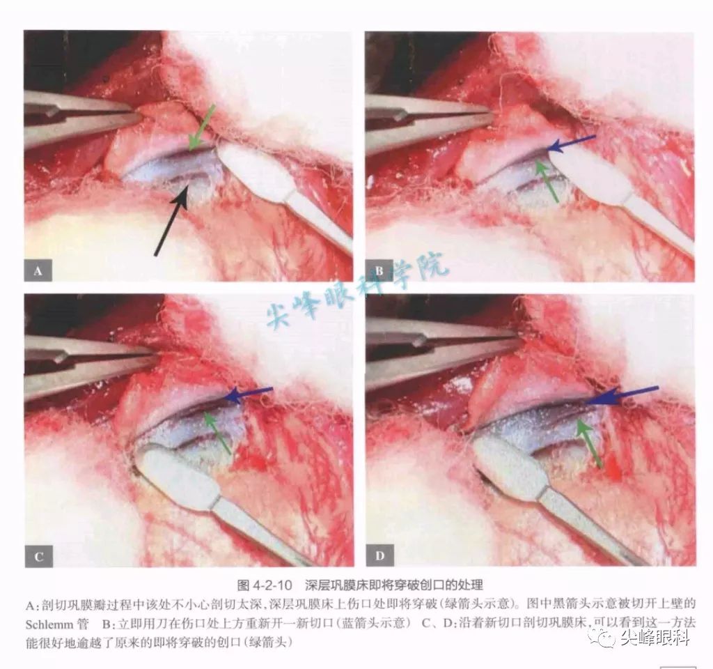 小梁切除术的手术技术和其它问题解答part3图解青光眼手术操作与技巧
