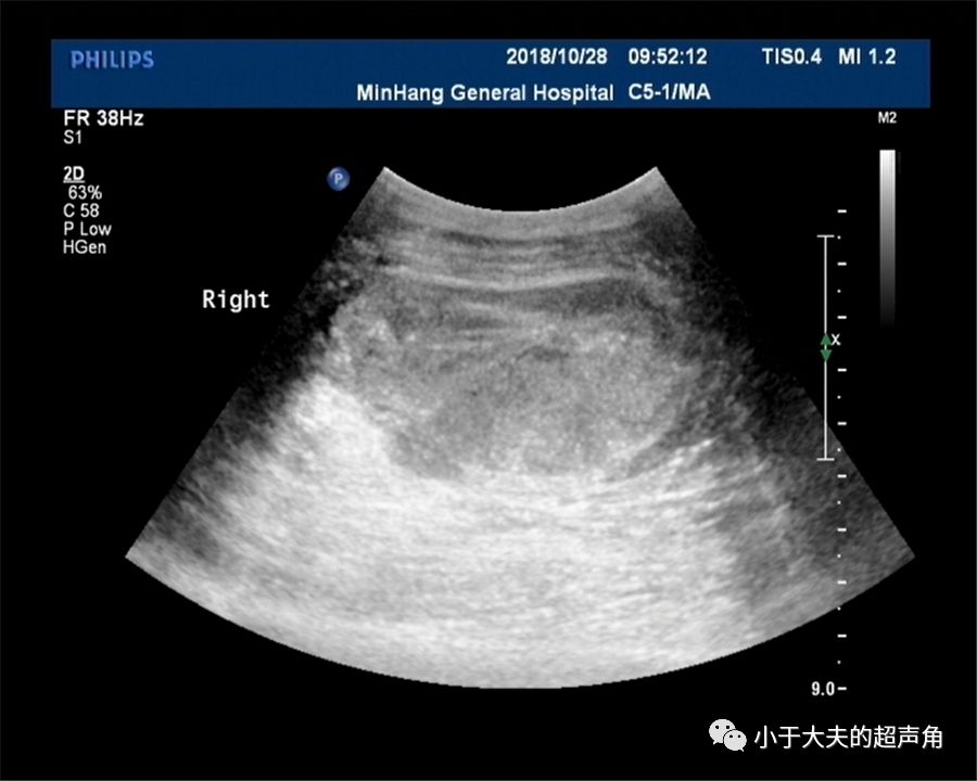 9cm,外形近橢圓形,邊界尚清,內部回聲不均勻,內可見不規則液性區,內部