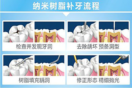 树脂补牙全过程图片图片