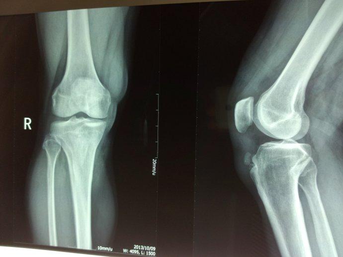 小腿胫骨骨膜增厚图片图片