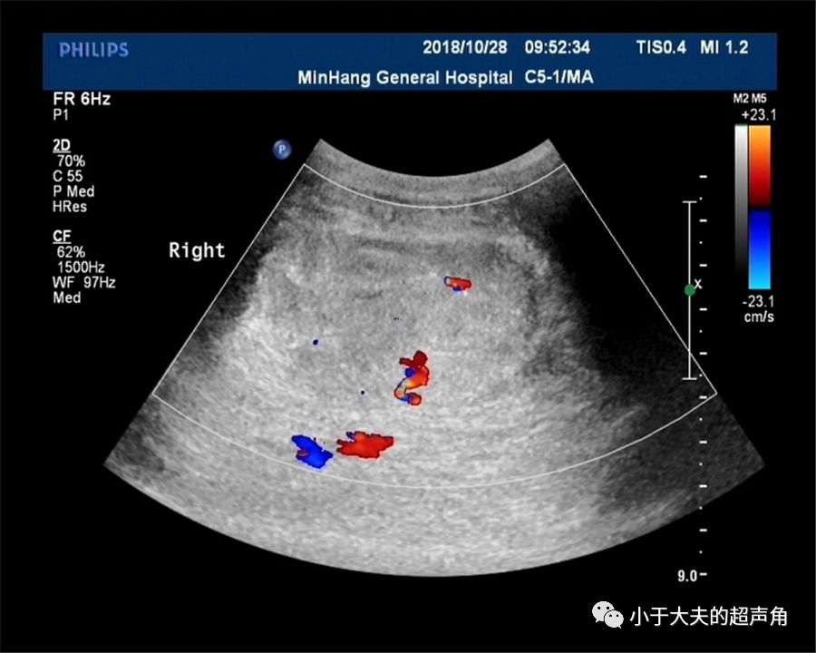 粘液性囊腺瘤超声图片