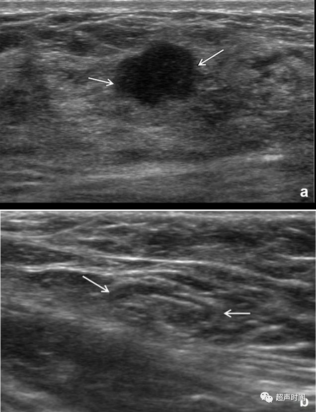 乳腺癌早期彩超图片图片
