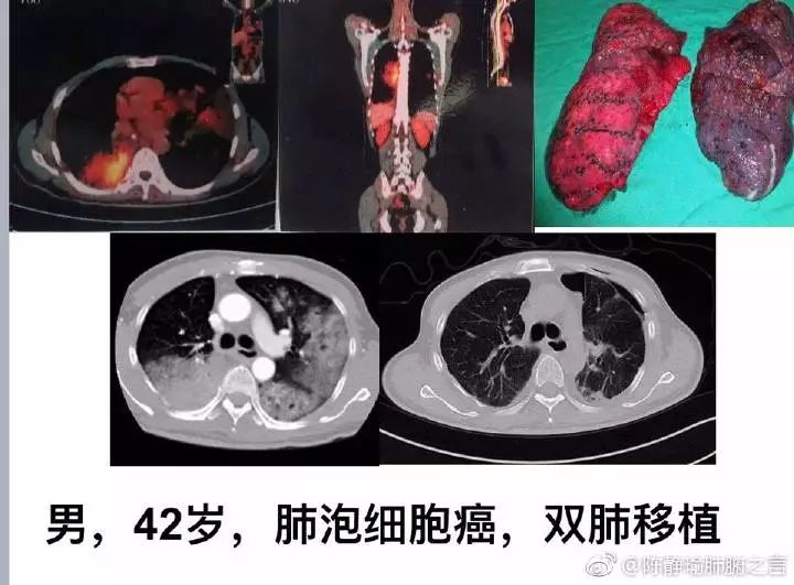 分享陈静瑜肺移植治疗肺部肿瘤