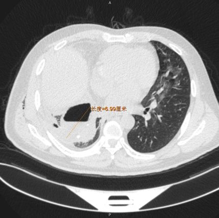 ct提示右側胸腔後下方可見包裹性液氣胸,兩肺斑片影,殘腔直徑約6.