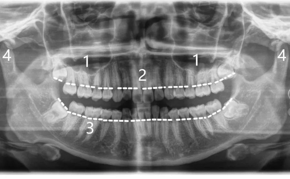 4:髁突3:牙根2:牙槽骨1:上颌窦在正式学习之前,我们先来认识几个专业