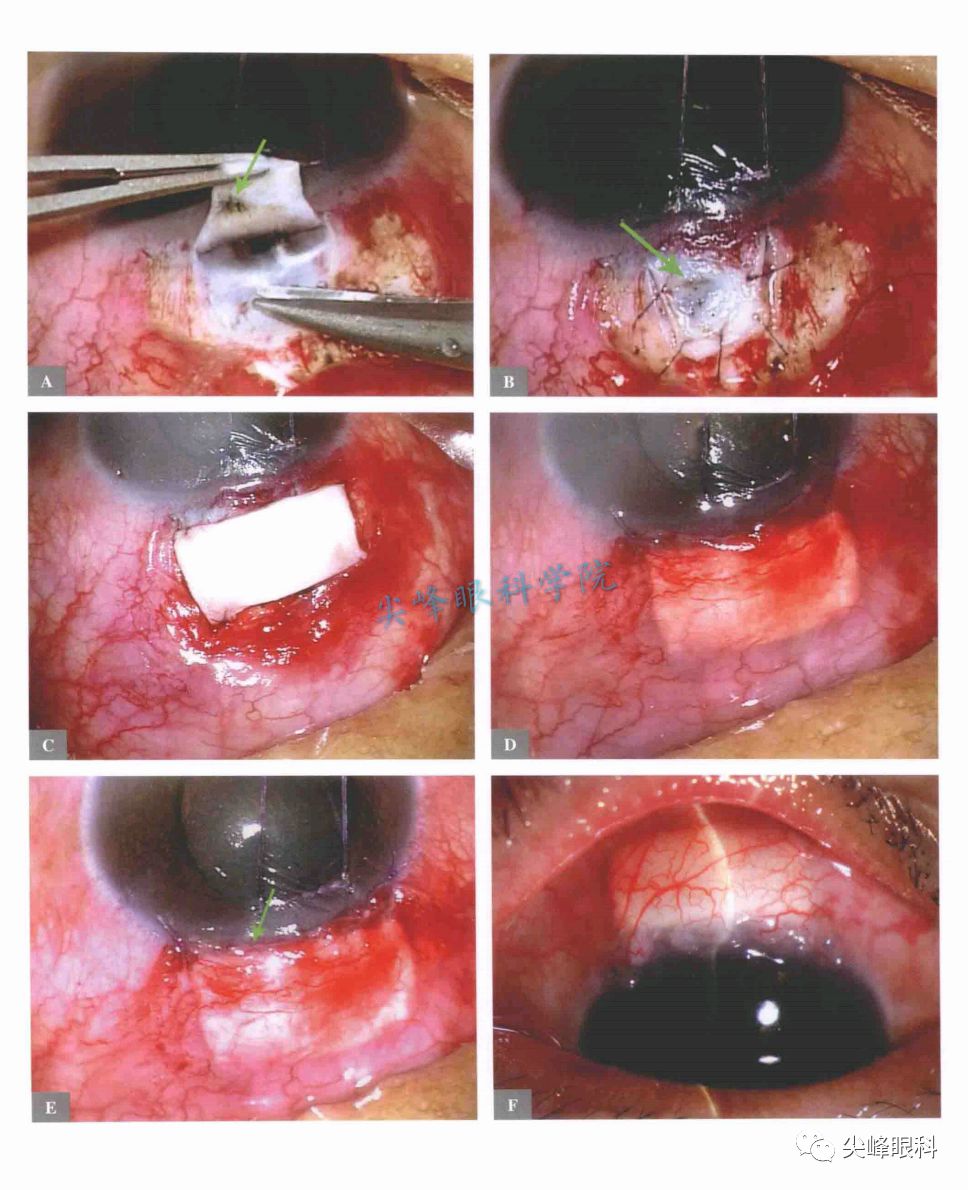 小梁切除术的手术技术和其它问题解答part4图解青光眼手术操作与技巧