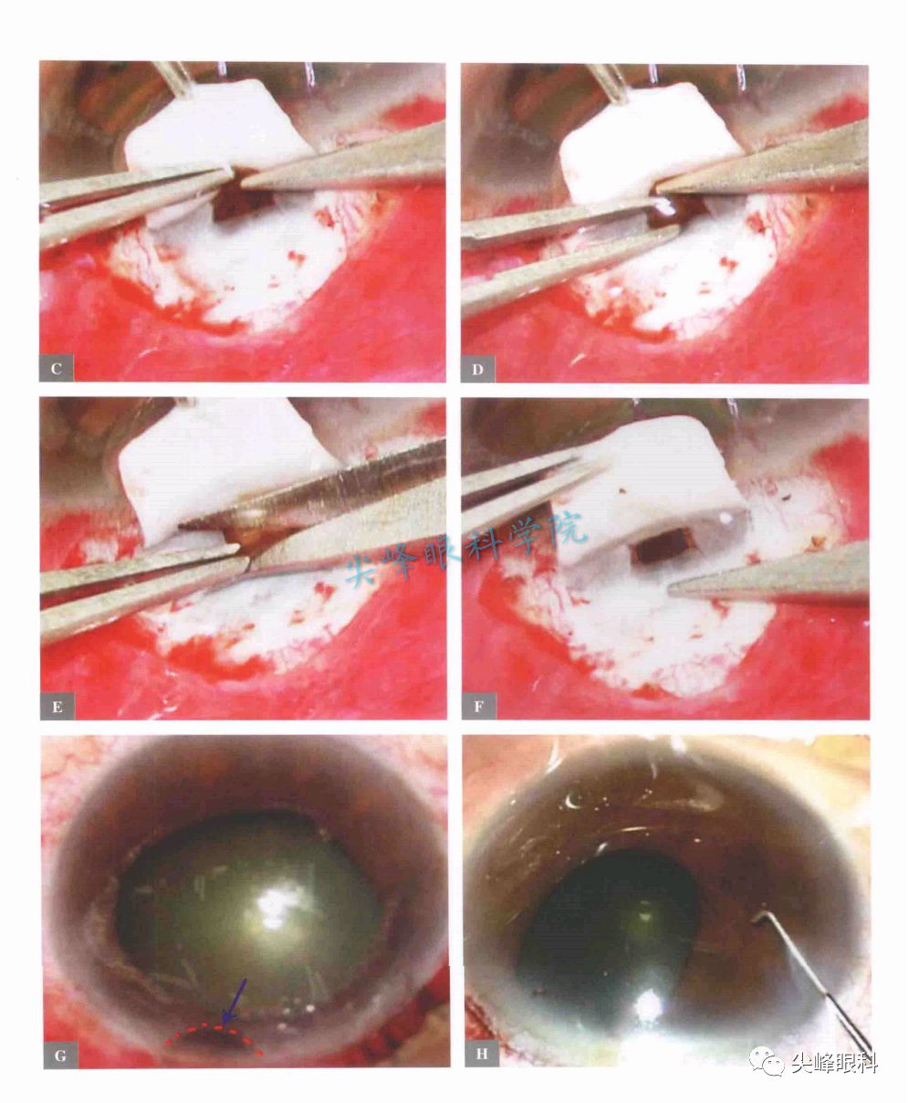 小梁切除术的手术技术和其它问题解答part4图解青光眼手术操作与技巧