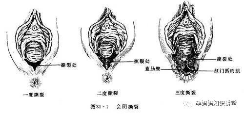 分娩 撕裂宫颈图片