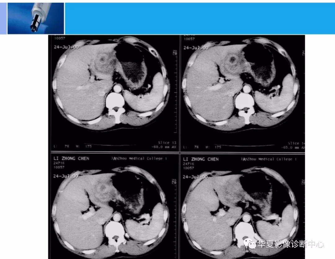 精華肝臟的ct影像診斷最全版