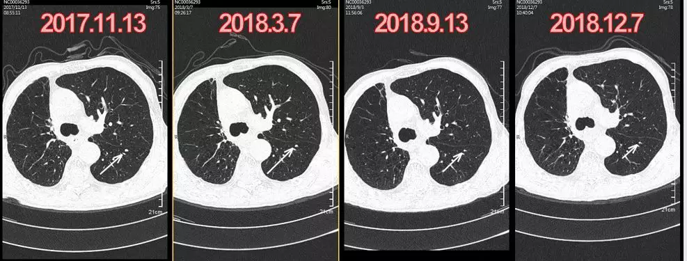 肺癌病例貝伐珠單抗治療肺腺癌