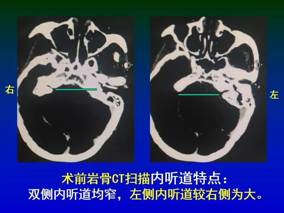 内听道ct解剖图图片