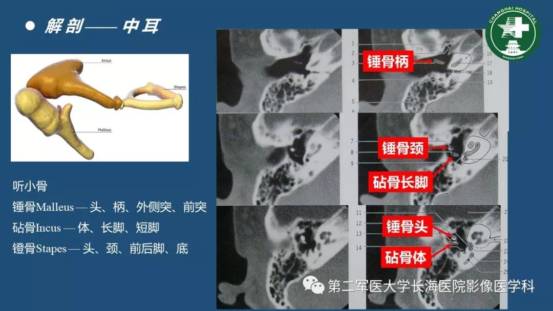 顳骨ct解剖及其常見病變