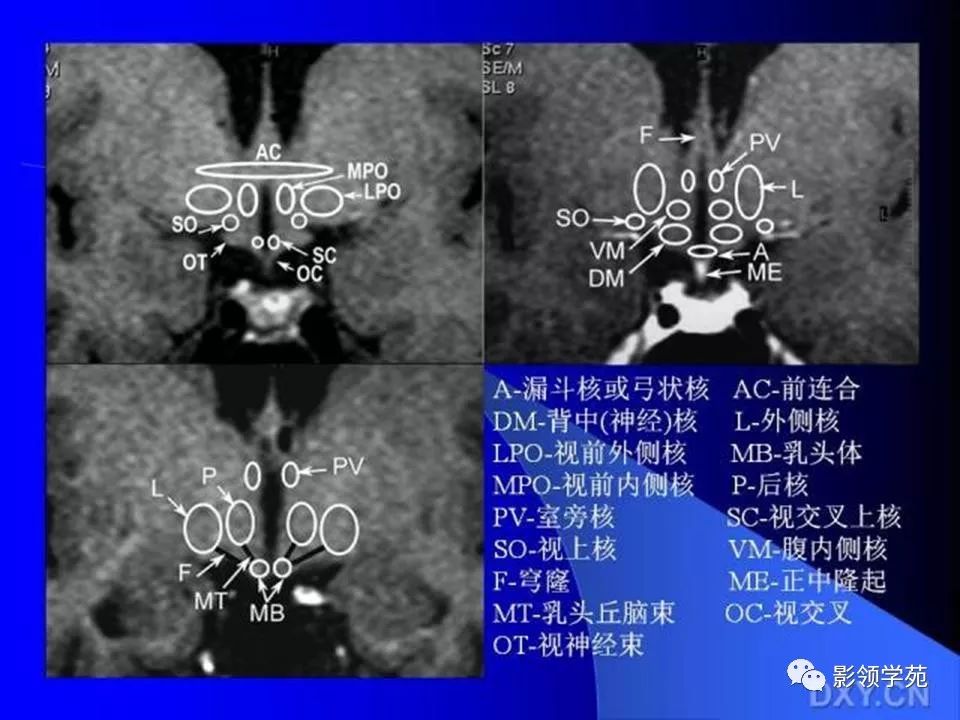 垂體瘤的mri診斷及鑑別診斷