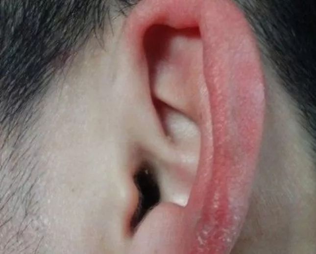冬季耳朵冻伤怎么办教你4种方法解决耳朵冻伤问题效果看得见