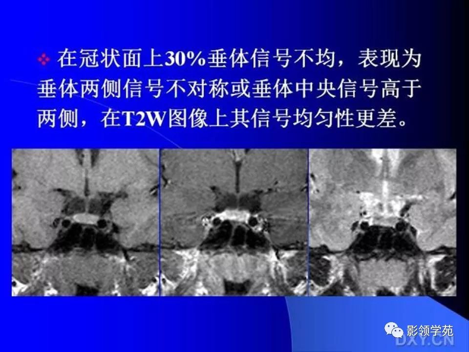 垂體瘤的mri診斷及鑑別診斷