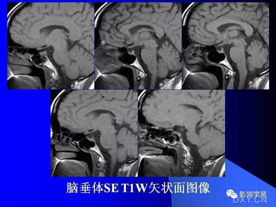 垂體瘤的mri診斷及鑑別診斷