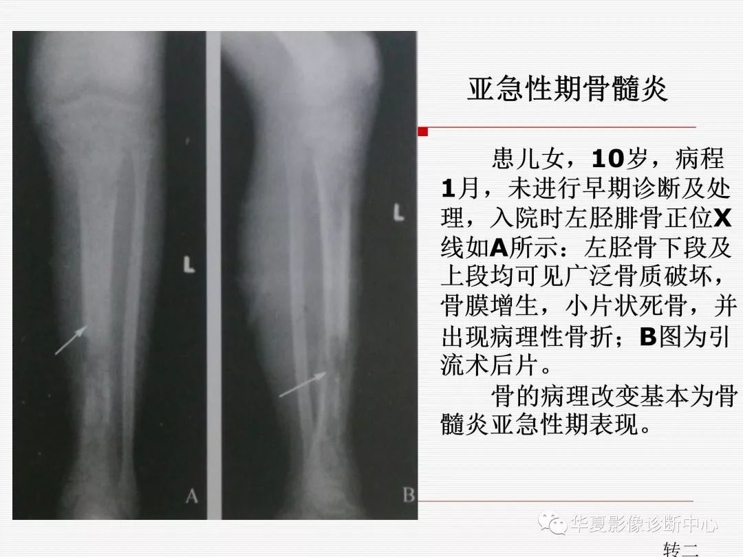 骨髓炎的影像學表現