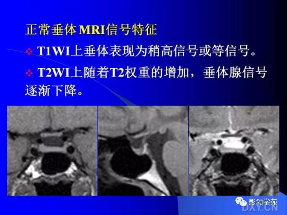 垂體瘤的mri診斷及鑑別診斷