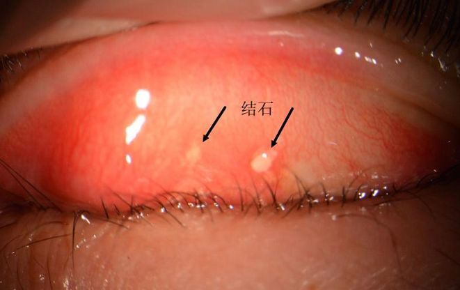 眼结石初期症状图片图片