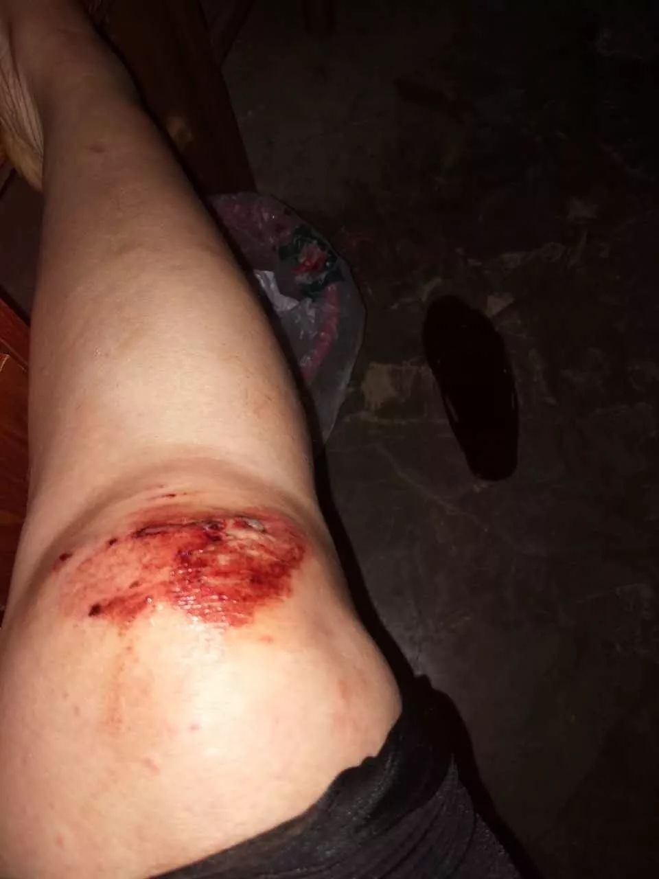 骑摩托车摔伤真实图片图片
