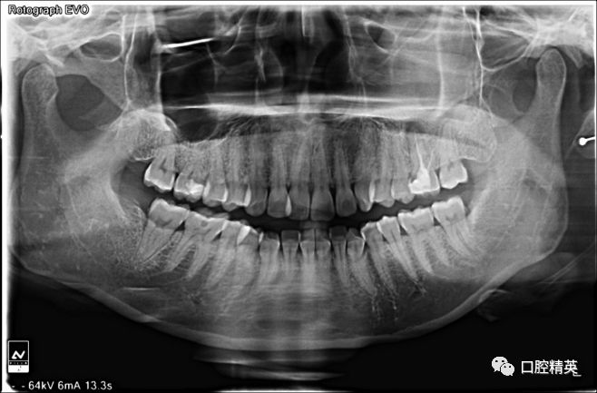 左上尖牙近中傾斜前牙中度擁擠雙側上頜第一磨牙死髓牙檢查矯正前照片