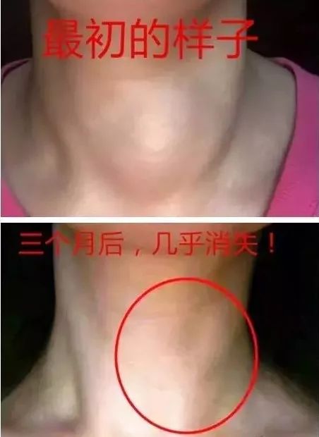 正常脖子和甲状腺脖子图片