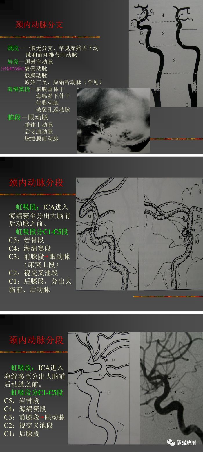 右侧颈内动脉虹吸段图片