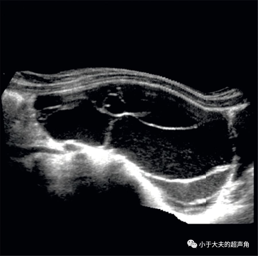 粘液性囊腺瘤超声图片