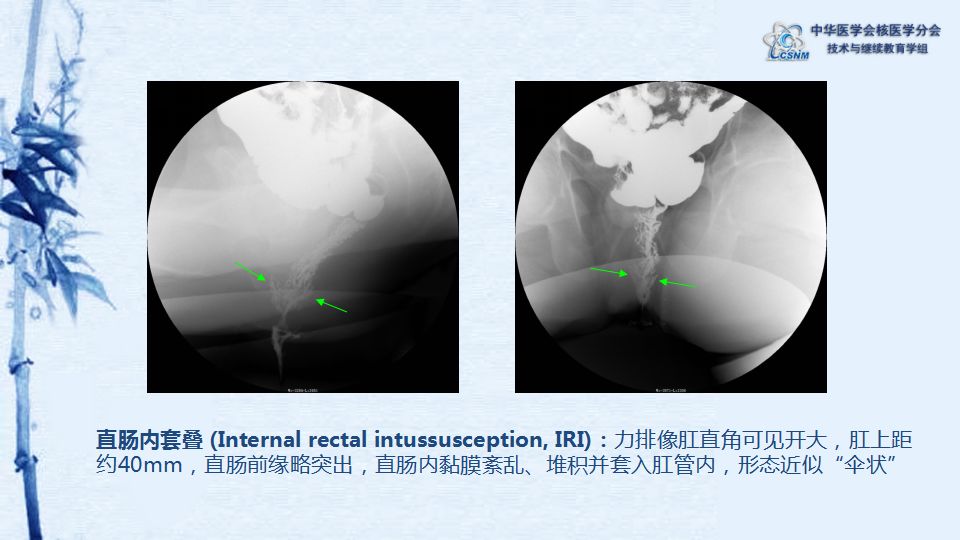 【讲座】33期:王闯 x线排粪造影诊断功能性便秘
