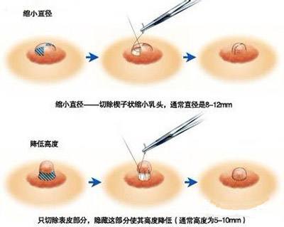 女性乳头内陷,5种方法帮你拔出来!