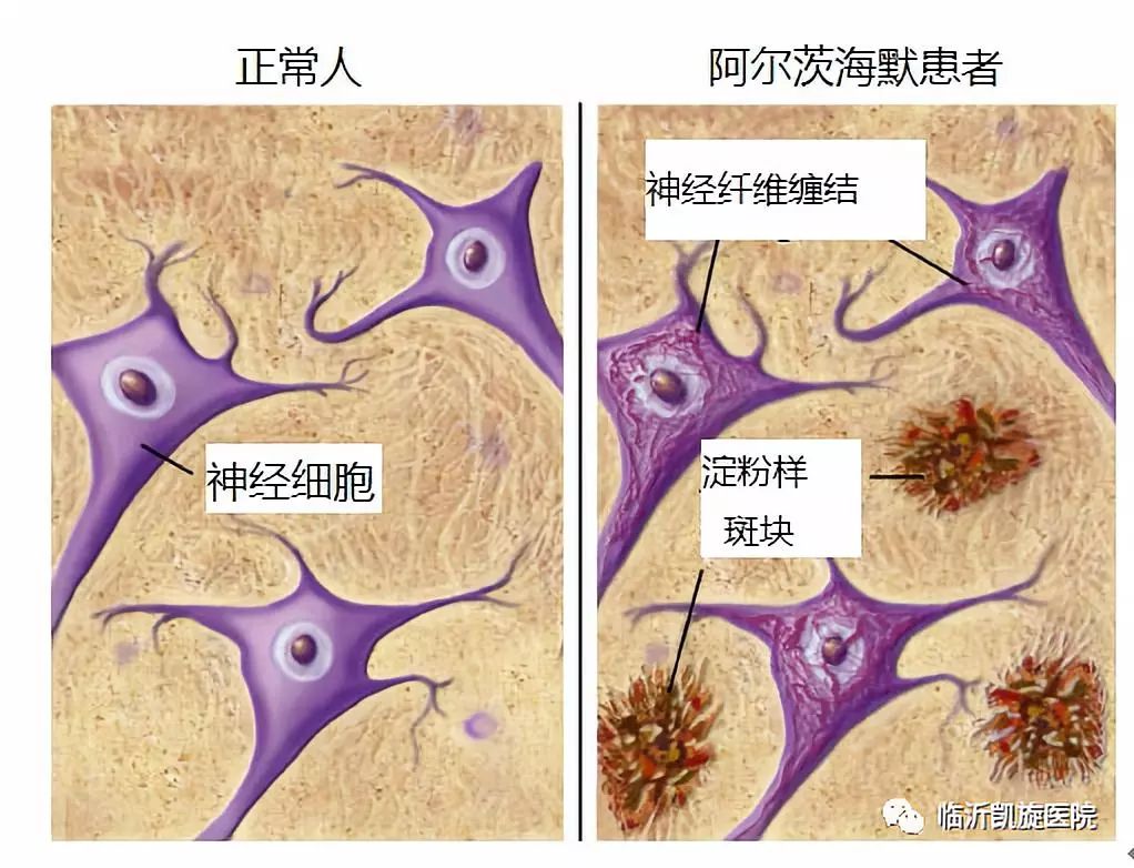 阿尔兹海默症护理六大要点