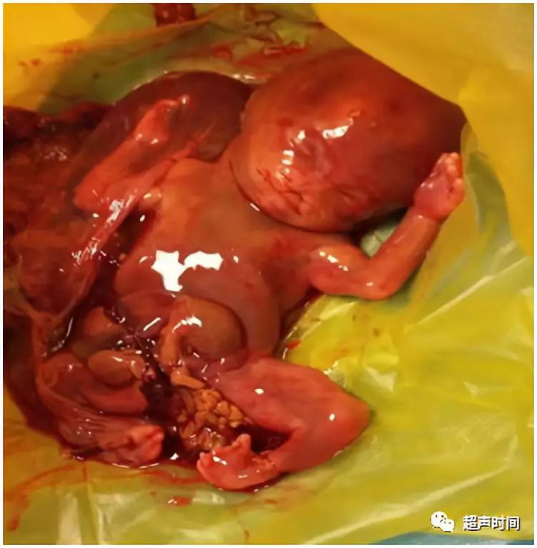 怀孕16周引产胎儿图片图片